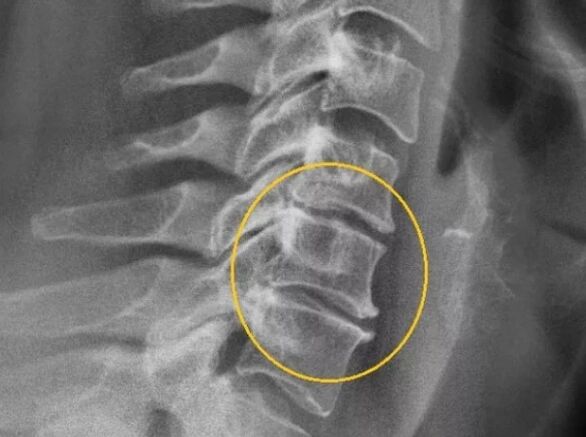 Osteohondroza kralježnice grlića maternice na x -ray