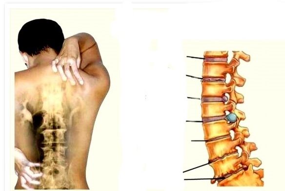 osteohondroza je uzrok bolova u leđima